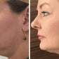 Facial Lifting Device Photon Therapy