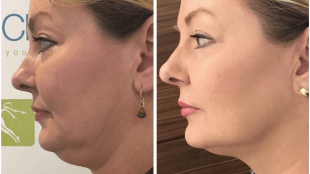 Facial Lifting Device Photon Therapy